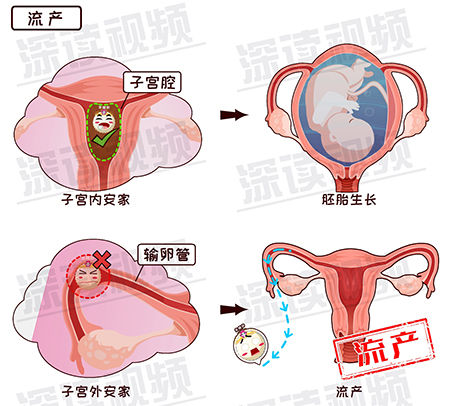 宫外孕-1-6.jpg