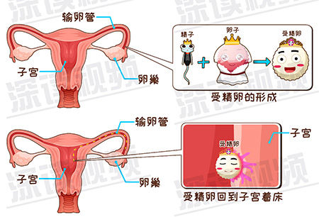宫外孕-2-3.jpg