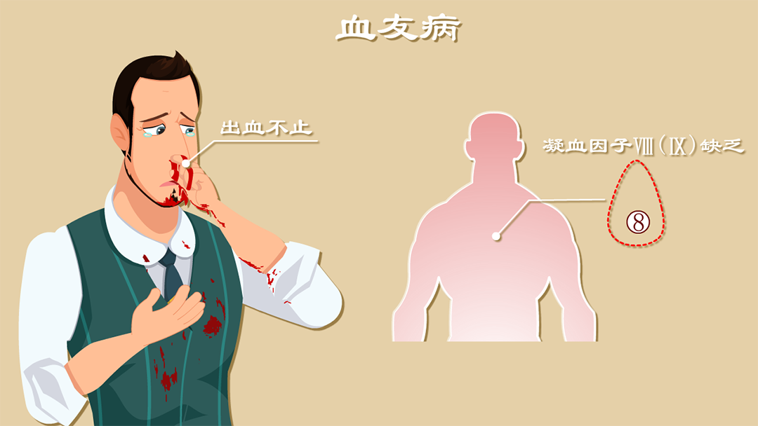 血友病-病因篇